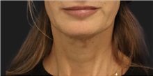 Neck Lift Before Photo by Munique Maia, MD; Tysons Corner, VA - Case 49386