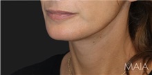 Neck Lift After Photo by Munique Maia, MD; Tysons Corner, VA - Case 49386