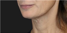 Neck Lift Before Photo by Munique Maia, MD; Tysons Corner, VA - Case 49386