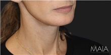 Neck Lift After Photo by Munique Maia, MD; Tysons Corner, VA - Case 49386