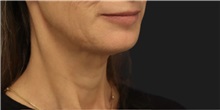 Neck Lift Before Photo by Munique Maia, MD; Tysons Corner, VA - Case 49386