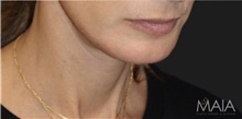 Neck Lift After Photo by Munique Maia, MD; Tysons Corner, VA - Case 49386