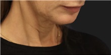 Neck Lift Before Photo by Munique Maia, MD; Tysons Corner, VA - Case 49386