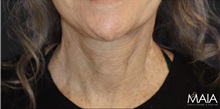 Neck Lift After Photo by Munique Maia, MD; Tysons Corner, VA - Case 49387