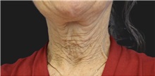 Neck Lift Before Photo by Munique Maia, MD; Tysons Corner, VA - Case 49387