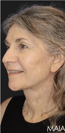 Neck Lift After Photo by Munique Maia, MD; Tysons Corner, VA - Case 49387