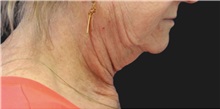 Neck Lift Before Photo by Munique Maia, MD; Tysons Corner, VA - Case 49371