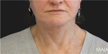 Neck Lift After Photo by Munique Maia, MD; Tysons Corner, VA - Case 49371