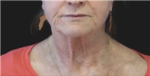 Neck Lift Before Photo by Munique Maia, MD; Tysons Corner, VA - Case 49371