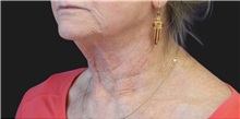 Neck Lift Before Photo by Munique Maia, MD; Tysons Corner, VA - Case 49371