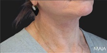 Neck Lift After Photo by Munique Maia, MD; Tysons Corner, VA - Case 49371