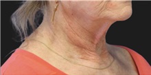 Neck Lift Before Photo by Munique Maia, MD; Tysons Corner, VA - Case 49371