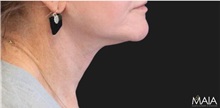 Neck Lift After Photo by Munique Maia, MD; Tysons Corner, VA - Case 49371