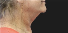 Neck Lift Before Photo by Munique Maia, MD; Tysons Corner, VA - Case 49371