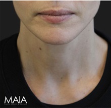 Neck Lift After Photo by Munique Maia, MD; Tysons Corner, VA - Case 49395