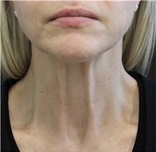 Neck Lift Before Photo by Munique Maia, MD; Tysons Corner, VA - Case 49395