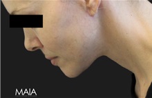 Neck Lift After Photo by Munique Maia, MD; Tysons Corner, VA - Case 49395