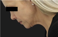 Neck Lift Before Photo by Munique Maia, MD; Tysons Corner, VA - Case 49395