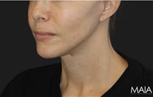 Neck Lift After Photo by Munique Maia, MD; Tysons Corner, VA - Case 49395