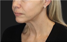 Neck Lift Before Photo by Munique Maia, MD; Tysons Corner, VA - Case 49395