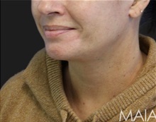 Neck Lift After Photo by Munique Maia, MD; Tysons Corner, VA - Case 49394