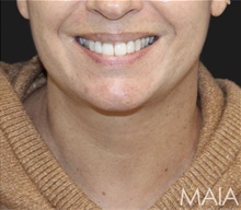 Neck Lift After Photo by Munique Maia, MD; Tysons Corner, VA - Case 49394