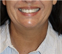 Neck Lift Before Photo by Munique Maia, MD; Tysons Corner, VA - Case 49394