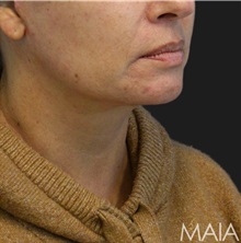 Neck Lift After Photo by Munique Maia, MD; Tysons Corner, VA - Case 49394