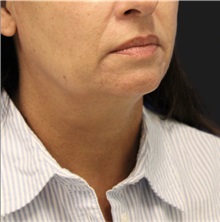 Neck Lift Before Photo by Munique Maia, MD; Tysons Corner, VA - Case 49394