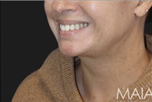 Neck Lift After Photo by Munique Maia, MD; Tysons Corner, VA - Case 49394