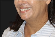 Neck Lift Before Photo by Munique Maia, MD; Tysons Corner, VA - Case 49394