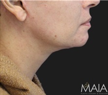 Neck Lift After Photo by Munique Maia, MD; Tysons Corner, VA - Case 49394