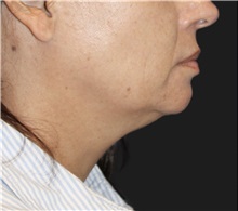 Neck Lift Before Photo by Munique Maia, MD; Tysons Corner, VA - Case 49394