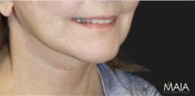 Neck Lift After Photo by Munique Maia, MD; Tysons Corner, VA - Case 49373