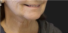 Neck Lift Before Photo by Munique Maia, MD; Tysons Corner, VA - Case 49373