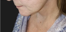 Neck Lift After Photo by Munique Maia, MD; Tysons Corner, VA - Case 49373