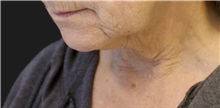 Neck Lift Before Photo by Munique Maia, MD; Tysons Corner, VA - Case 49373