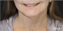 Neck Lift After Photo by Munique Maia, MD; Tysons Corner, VA - Case 49373