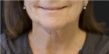 Neck Lift Before Photo by Munique Maia, MD; Tysons Corner, VA - Case 49373