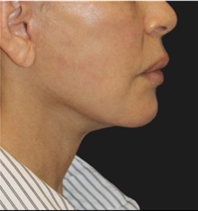 Neck Lift After Photo by Munique Maia, MD; Tysons Corner, VA - Case 49390