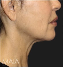 Neck Lift Before Photo by Munique Maia, MD; Tysons Corner, VA - Case 49390