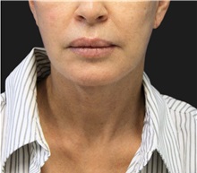 Neck Lift After Photo by Munique Maia, MD; Tysons Corner, VA - Case 49390