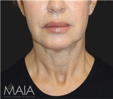 Neck Lift Before Photo by Munique Maia, MD; Tysons Corner, VA - Case 49390