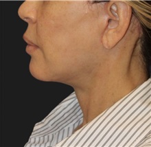 Neck Lift After Photo by Munique Maia, MD; Tysons Corner, VA - Case 49390