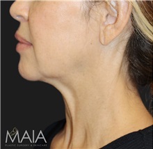 Neck Lift Before Photo by Munique Maia, MD; Tysons Corner, VA - Case 49390