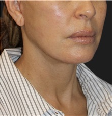 Neck Lift After Photo by Munique Maia, MD; Tysons Corner, VA - Case 49390