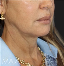 Neck Lift Before Photo by Munique Maia, MD; Tysons Corner, VA - Case 49390