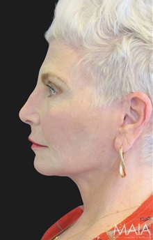 Neck Lift After Photo by Munique Maia, MD; Tysons Corner, VA - Case 49392