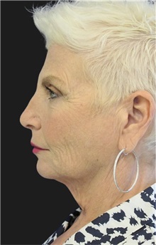 Neck Lift Before Photo by Munique Maia, MD; Tysons Corner, VA - Case 49392