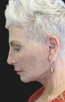 Neck Lift After Photo by Munique Maia, MD; Tysons Corner, VA - Case 49392